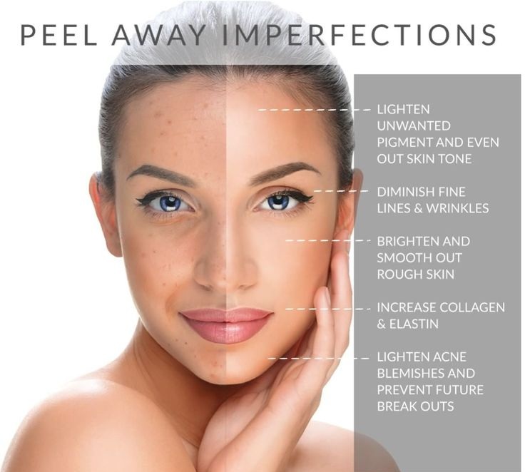Acne scarring